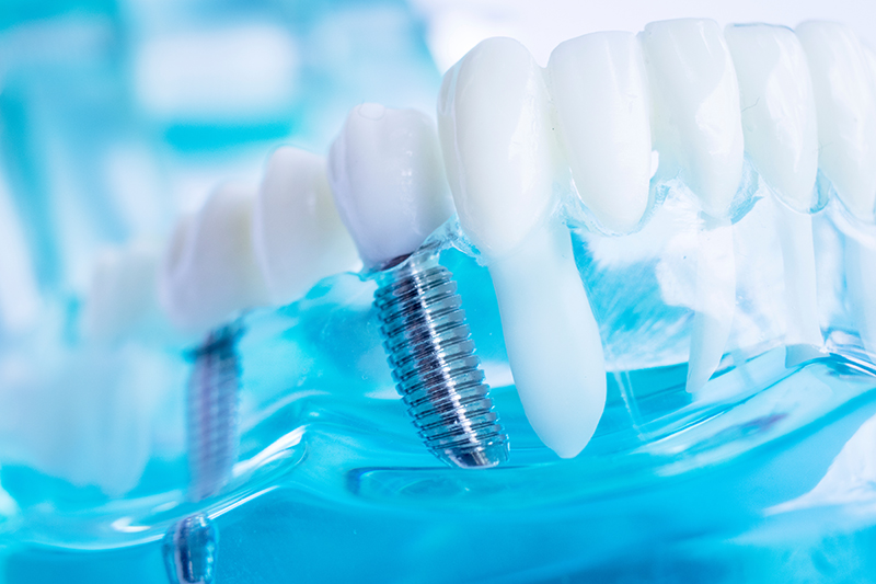 Lake Advanced Dentistry | Dental Sealants, Inlays  amp  Onlays and Dental Fillings