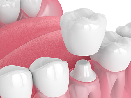Lake Advanced Dentistry | Implant Restorations, Implant Dentistry and Dental Bridges